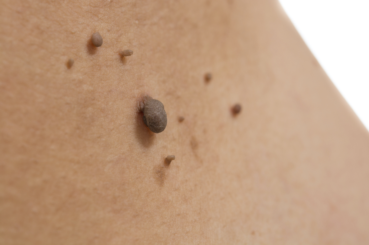 Skin Growths & Moles Treatment